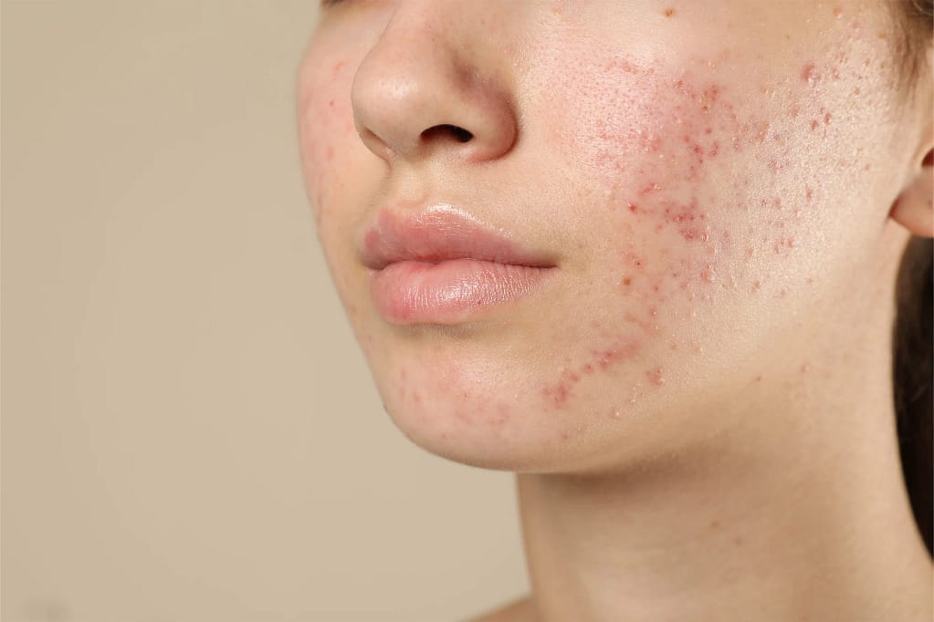 Acne Acne Treatment