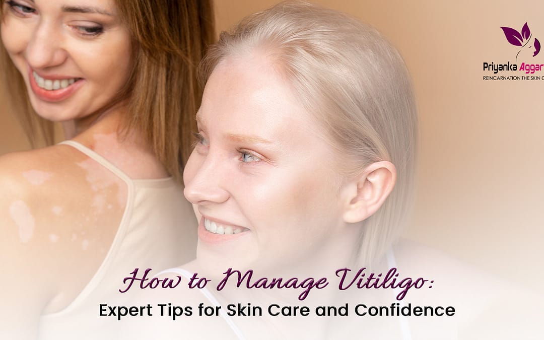 Manage Vitiligo