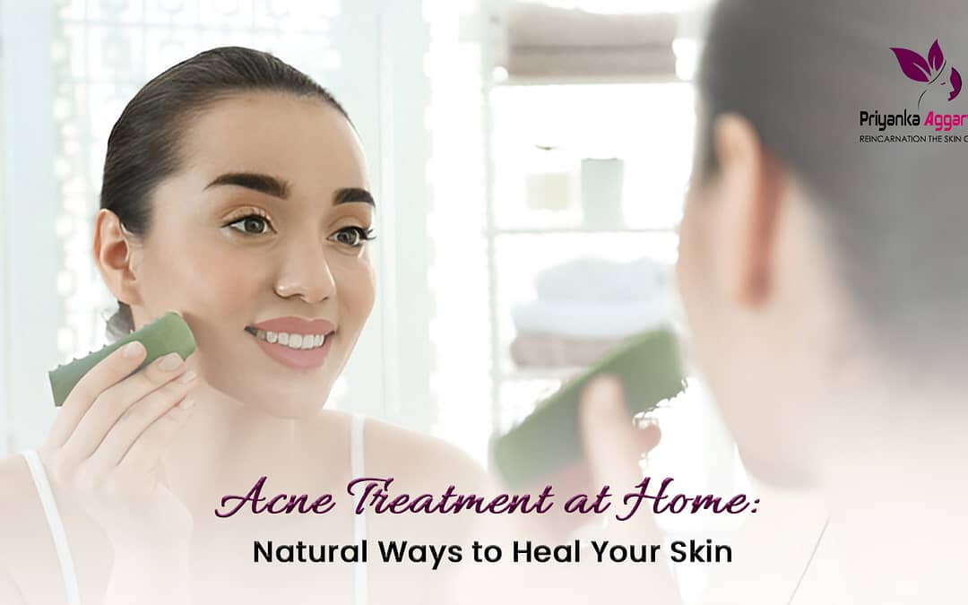 acne treatment at home