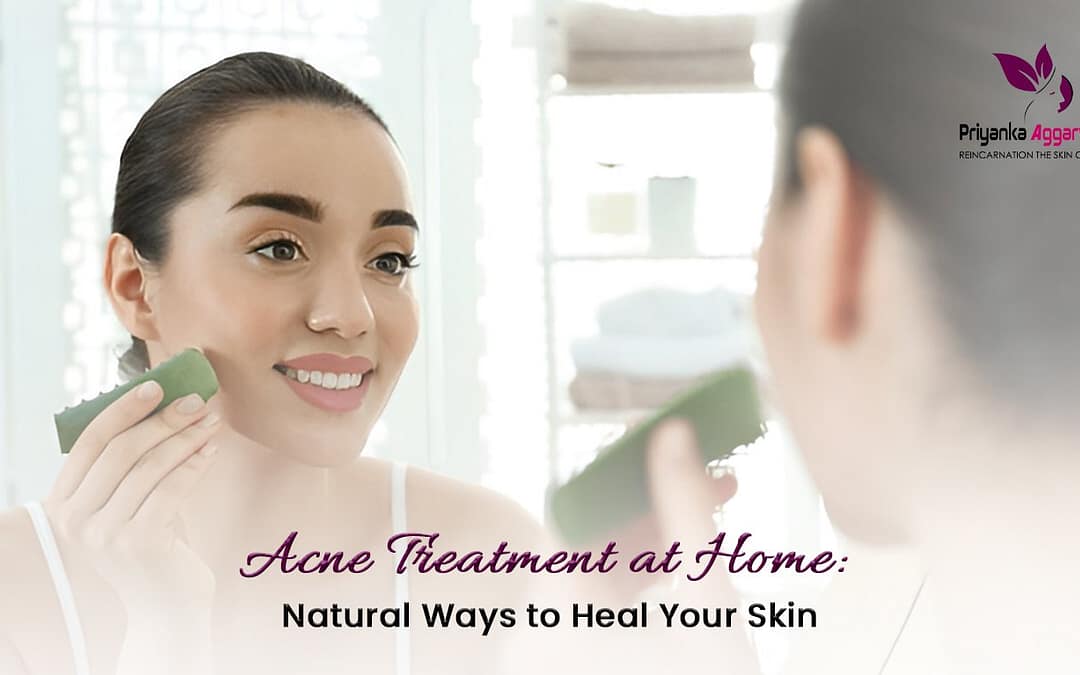 acne treatment at home