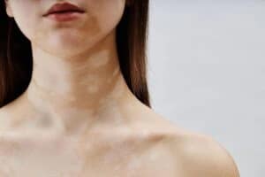 Preparing for vitiligo surgery: Evaluation, planning, and expectations vitiligo surgery evaluation procedure