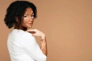 Preparing for vitiligo surgery: Evaluation, planning, and expectations Know about vitiligo surgery