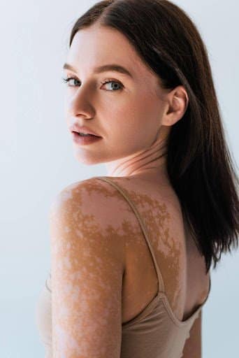 Can Targeted UV Light Really Bring Back Your Skin Colour? The Truth About Excimer Laser for Vitiligo Results and Timeline of Repigmentation