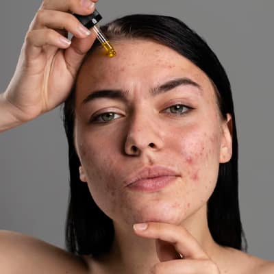 Acne Treatment at Home: Natural Ways to Heal Your Skin acne treatment at home