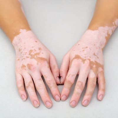 How to Manage Vitiligo: Expert Tips for Skin Care and Confidence Manage Vitiligo