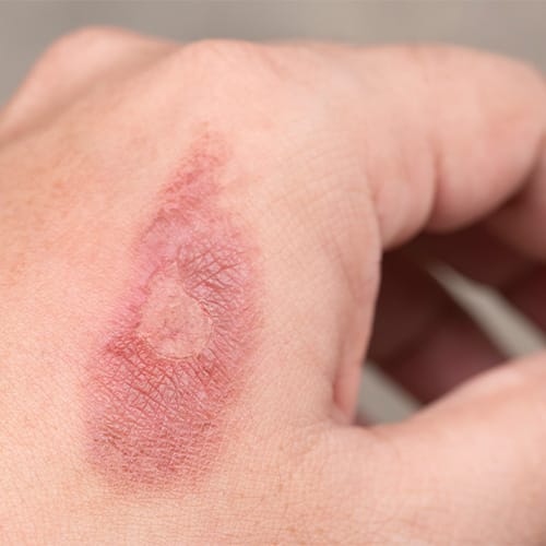 Skin Problems in Humid Climates: Your Guide to Happy, Healthy Skin! Humid Climates