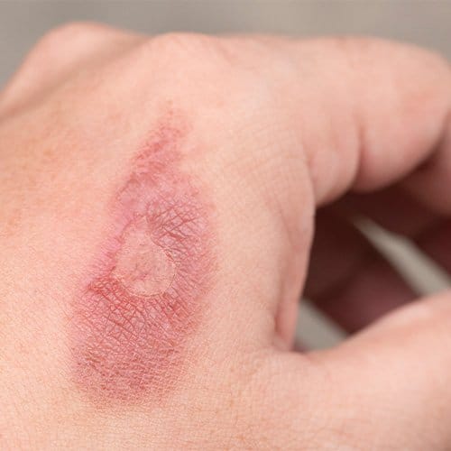 Skin Problems in Humid Climates: Your Guide to Happy, Healthy Skin! Humid Climates