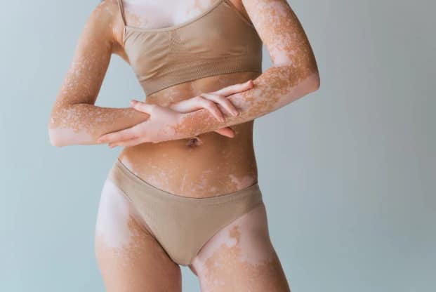Can Targeted UV Light Really Bring Back Your Skin Colour? The Truth About Excimer Laser for Vitiligo Excimer Laser Treatment for Vitiligo