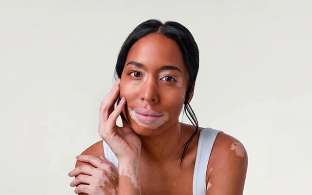 Preparing for vitiligo surgery