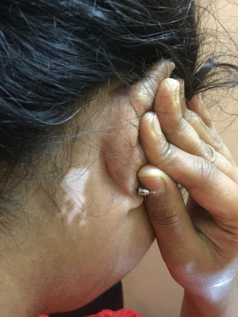 Vitiligo