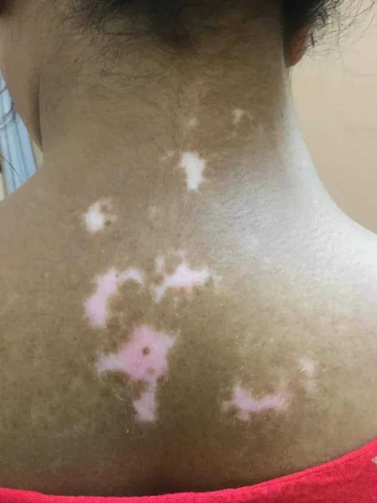 Vitiligo