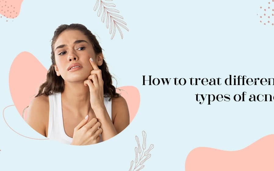 types of acne