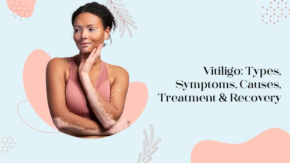 Vitiligo: Types, Symptoms, Causes, Treatment & Recovery